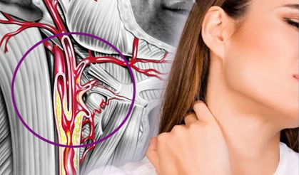 Şah Damarı Tıkanıklığı Felç Riskini Artırıyor, Uzmanından Uyarılar