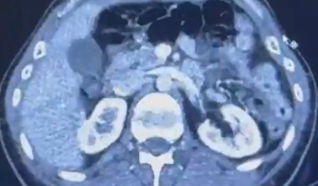 Ülkeye midelerinde uyuşturucu getiren şahıslar yakalandı