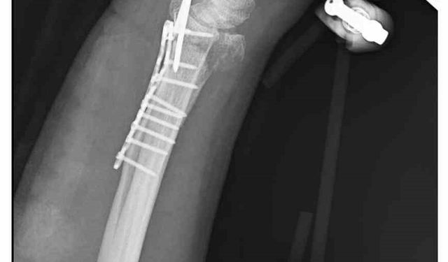 Sahipsiz köpeklerin saldırısından kaçmak isterken bileği kırıldı